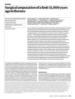 Surgical amputation of a limb 31,000 years ago in Borneo
